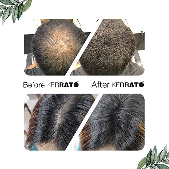 Kerrato Hair Fibres for Thinning Hair (NATURAL BLACK) Natural - 4g - Conceals Hair Loss in 10 seconds - Natural Hair Thickener & Fibers for Thin Hair for Men & Women